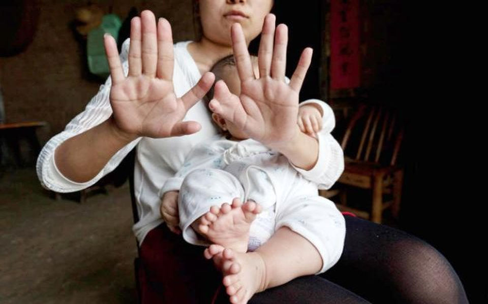 в Китае родился мальчик с 31 пальцем вместо 20