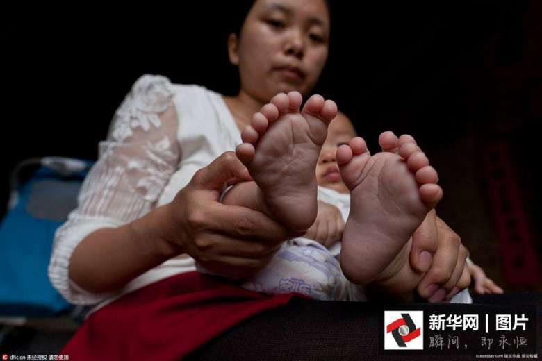 в Китае родился мальчик с 31 пальцем вместо 20