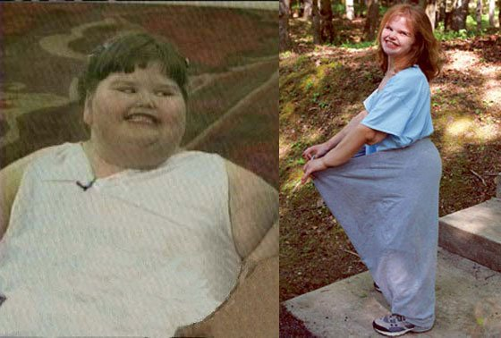 Самой толстой девочке в мире удалось похудеть. Вот как она выглядит сейчас