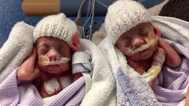 Это невероятно!: близнецы весом 450 гр победили смерть вопреки всем прогнозам